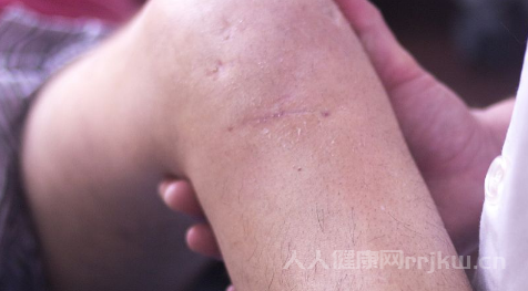 搔癢和瘙癢的區(qū)別