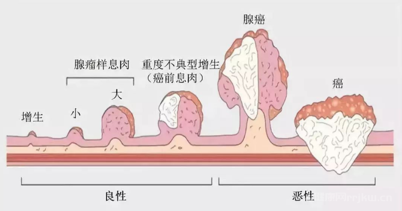 息肉和痔瘡區(qū)別圖