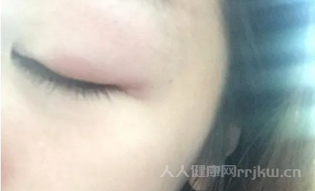 蚊子咬眼皮會(huì)腫很久嗎