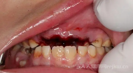 牙齒松動了怎么辦還能恢復(fù)嗎