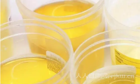 尿液發(fā)黃是什么原因