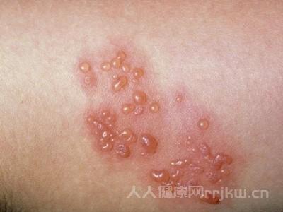 淋病的癥狀是什么樣