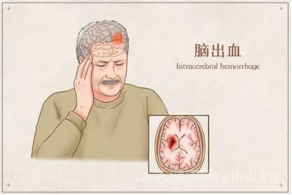 腦出血前的8個征兆一定要注意