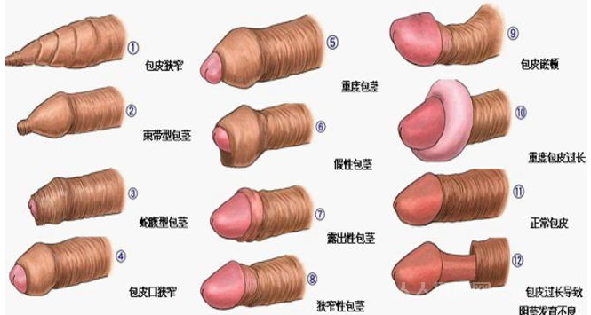 包皮過(guò)長(zhǎng)的危害
