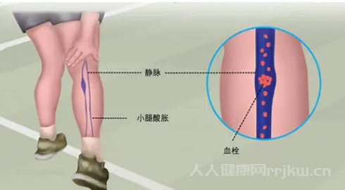 小腿酸脹警惕四種病日常預(yù)防措施