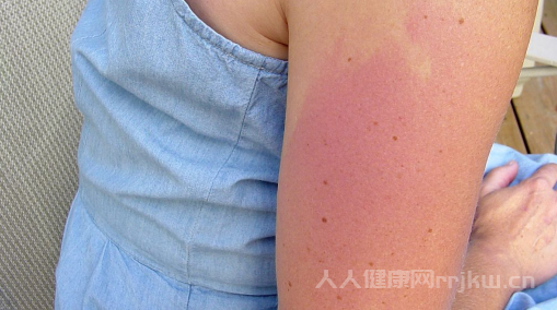 蕁麻疹晚上癢,有什么根治的方法嗎