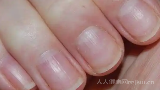 手指甲上有豎紋應(yīng)該吃什么？