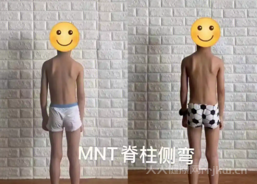 脊柱側彎自我矯正法