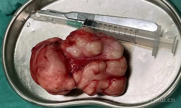 乳腺癌的復(fù)發(fā)率大概是多少？