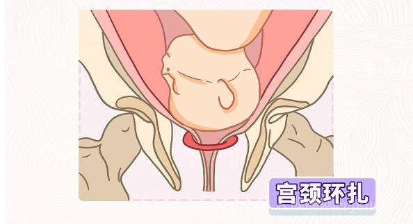 哪些人群不適合做宮頸環扎手術？
