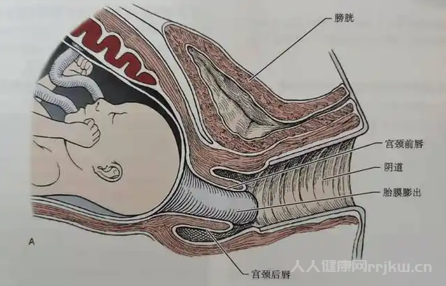 哪些孕婦不適合做宮頸環扎術？