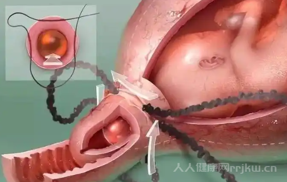 做宮頸環(huán)扎術(shù)的最佳時(shí)間是什么時(shí)候