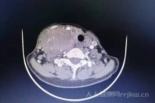 甲狀腺髓樣癌可以通過基因檢測來診斷嗎？