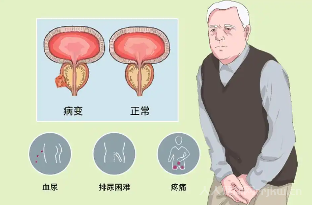 哪些生活方式可能影響前列腺癌三項化驗指標？
