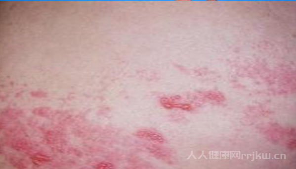 系統性紅斑狼瘡圖片,系統性紅斑狼瘡都有哪些癥狀？圖2