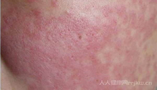 系統性紅斑狼瘡圖片,系統性紅斑狼瘡都有哪些癥狀？圖3