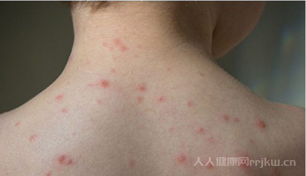 系統性紅斑狼瘡是什么病,系統性紅斑狼瘡早期癥狀有哪些