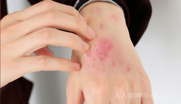 系統性紅斑狼瘡是什么病,系統性紅斑狼瘡早期癥狀有哪些